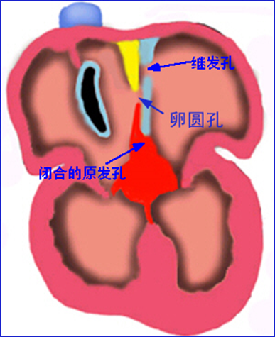 常见先天性心脏病