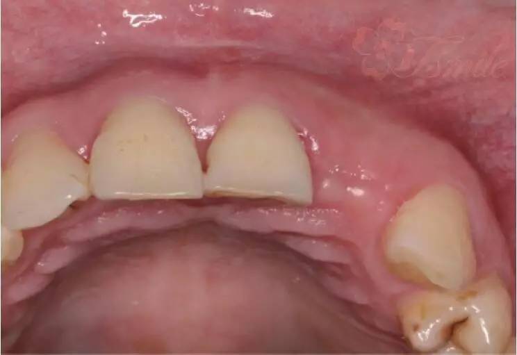 牙槽嵴低平图片