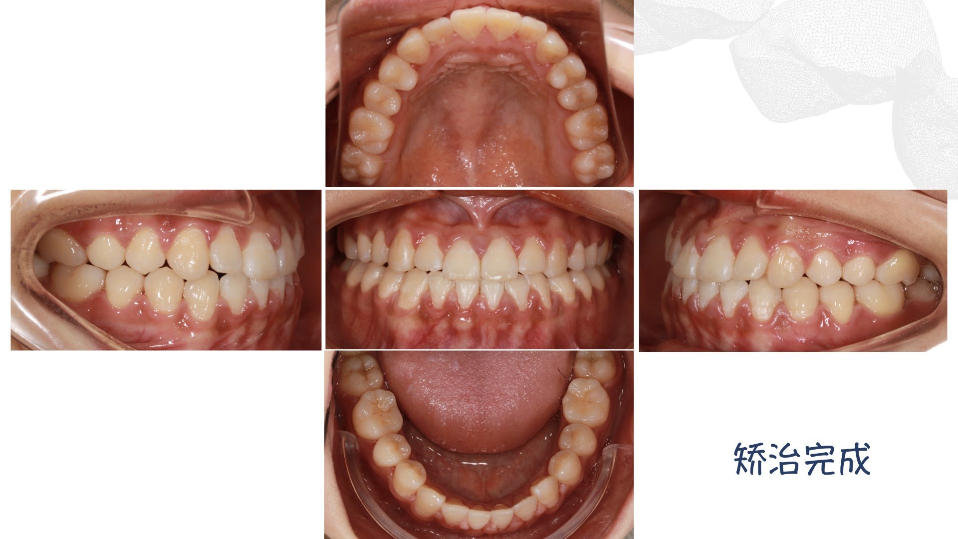 成人地包天矫正案例