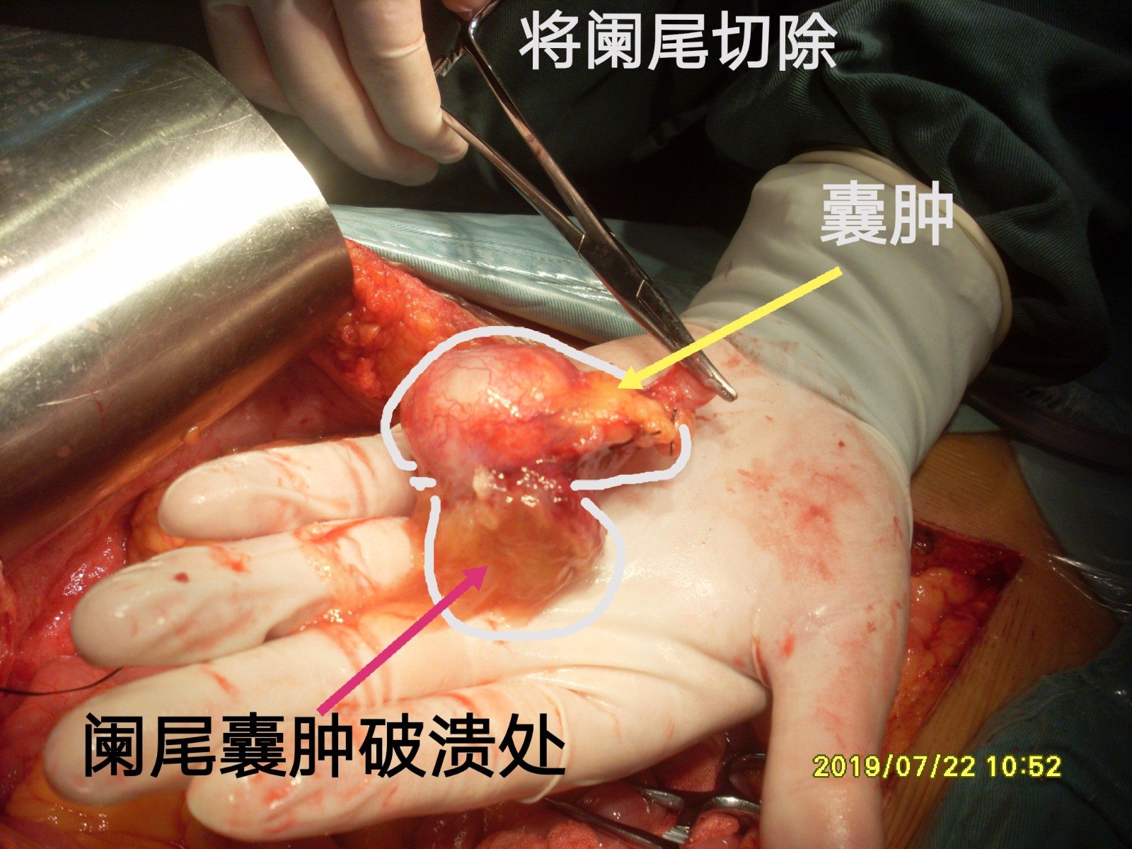 病例101阑尾囊肿经腹腔镜探查活检确诊pmp晚期经crshipec达ccr1