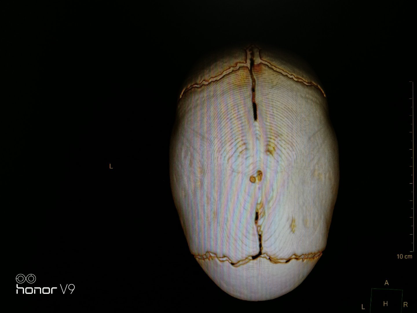 胎头矢状缝的位置图片图片