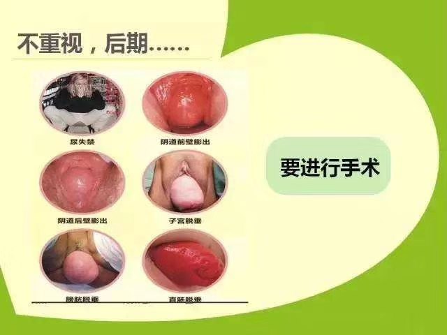 怎么知道子宫脱垂该手术了 子宫脱垂