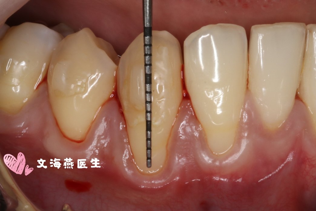 牙齦退縮治療案例_牙齦萎縮_牙齦萎縮治療方式 - 好大夫在線