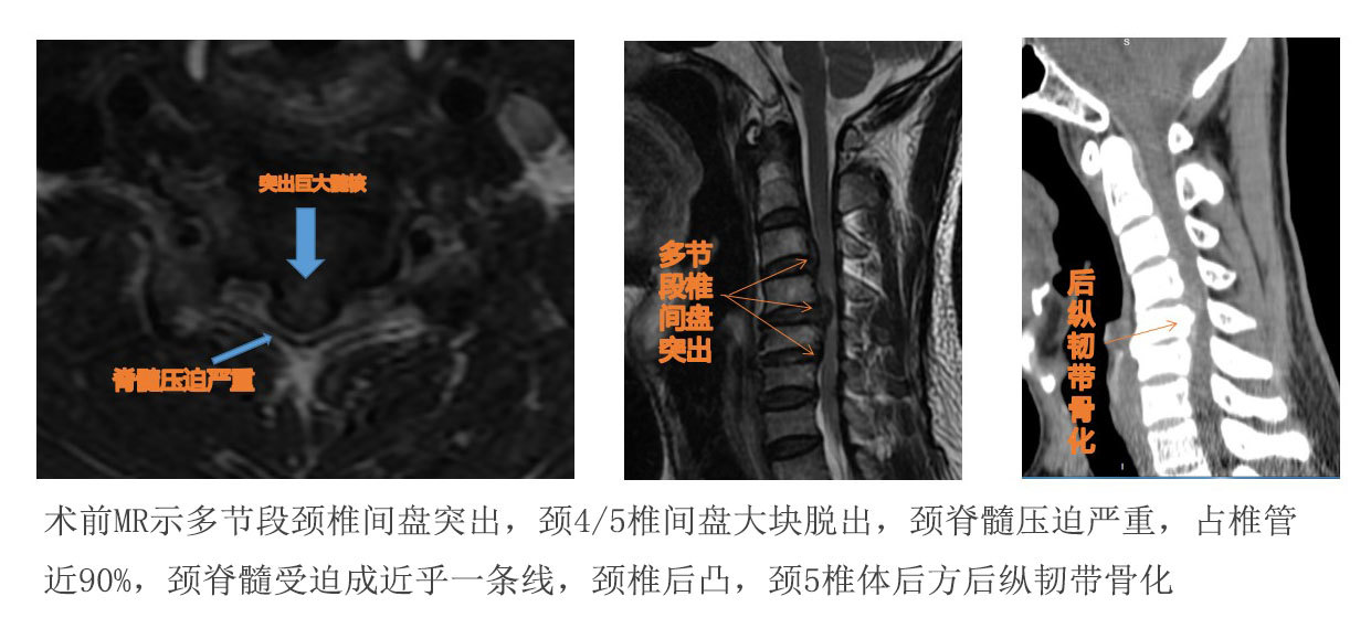 颈椎病严重突出术前jpg