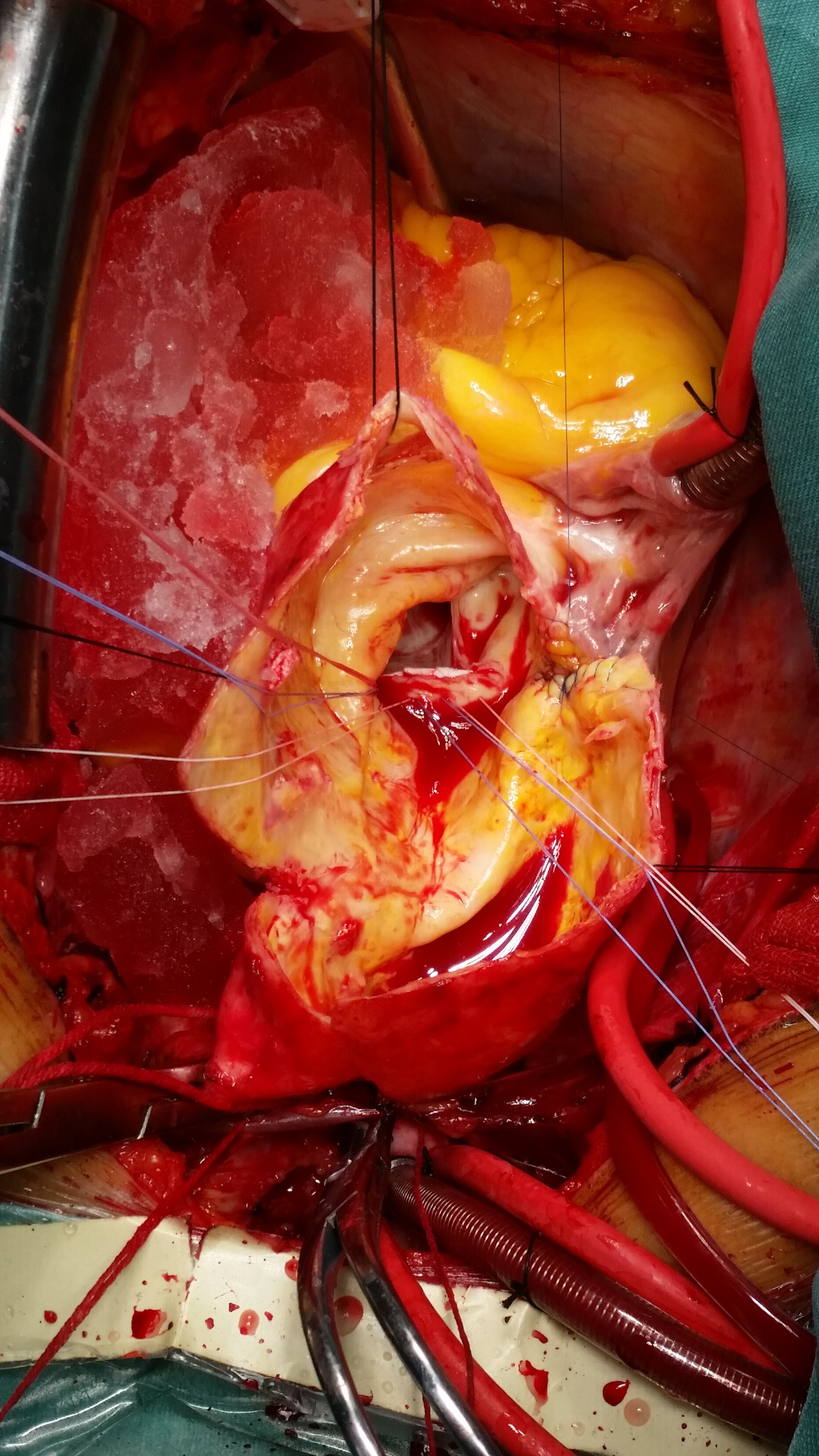 鸡蛋壳样升主动脉瘤 - 好大夫在线