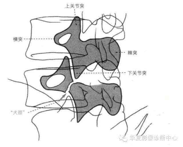 腰椎椎弓峡部解剖图片