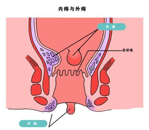 赘皮外痔图片