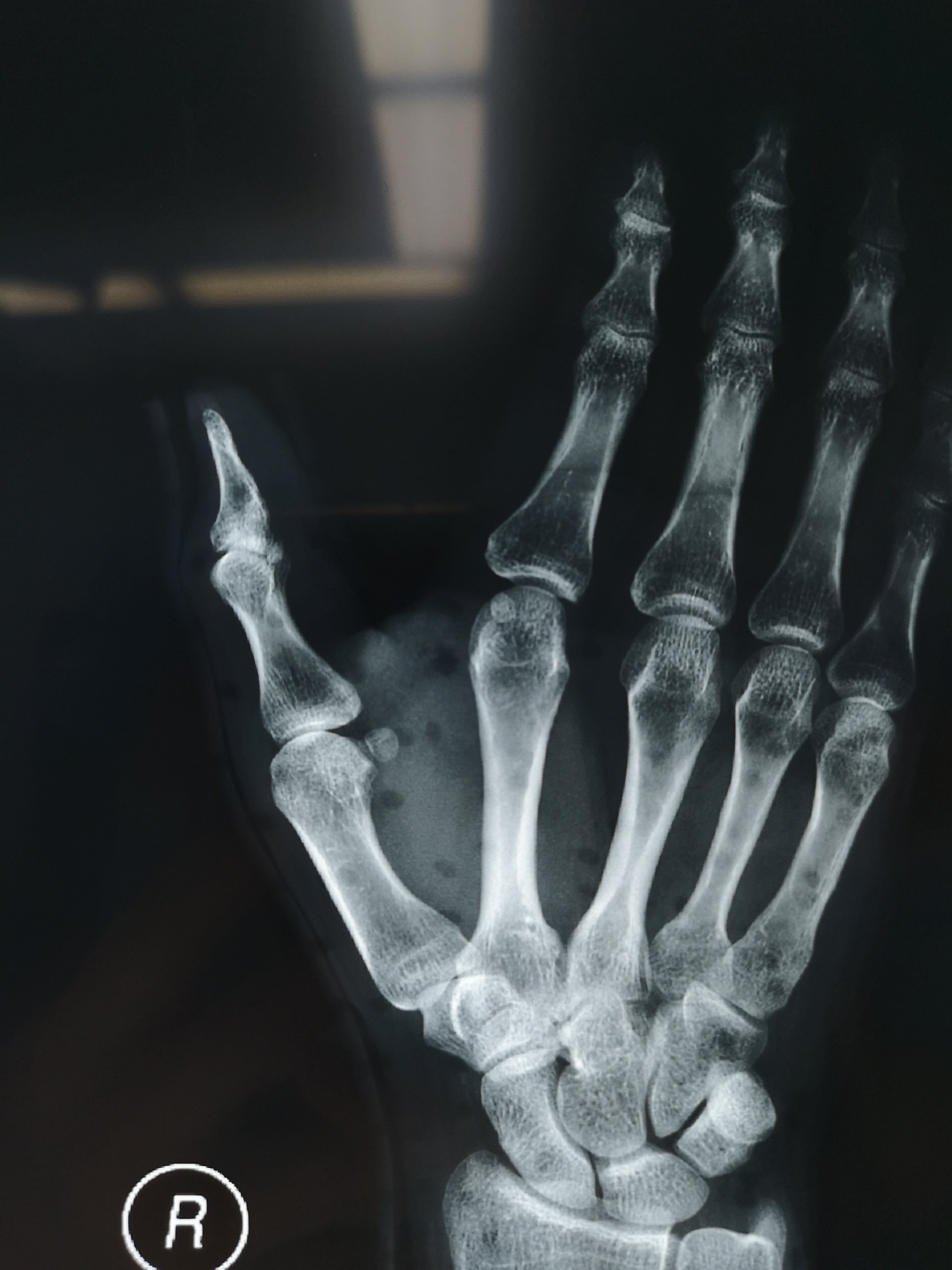 手骨折的x光片图片图片