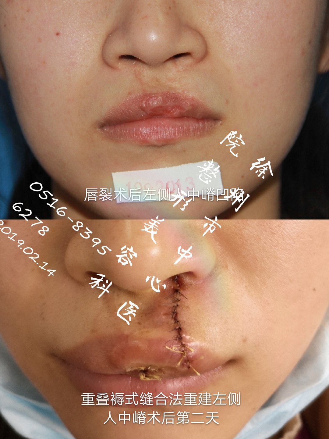 唇裂术后继发唇畸形 - 好大夫在线