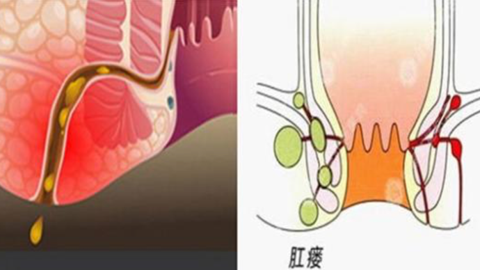 肛瘻手術後復發的前兆