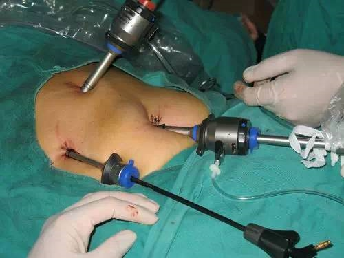 微创胆结石手术过程图片