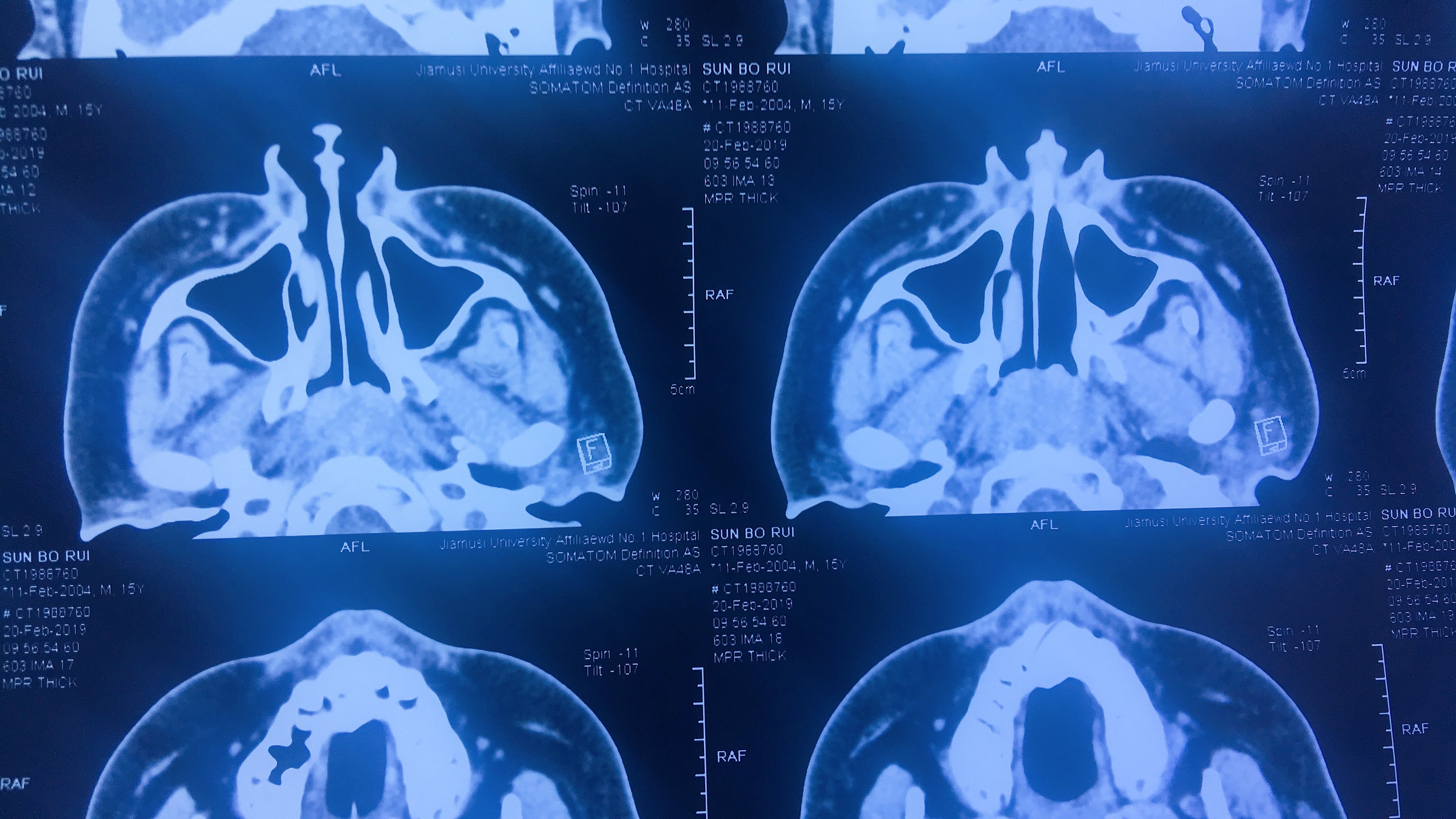 腺样体肥大CT图像图片