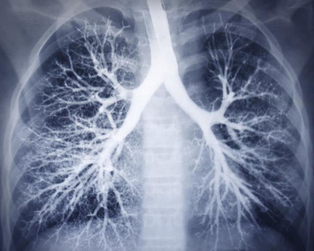支气管扩张气喘要注意,一般治疗效果差,医生总结可能是这五