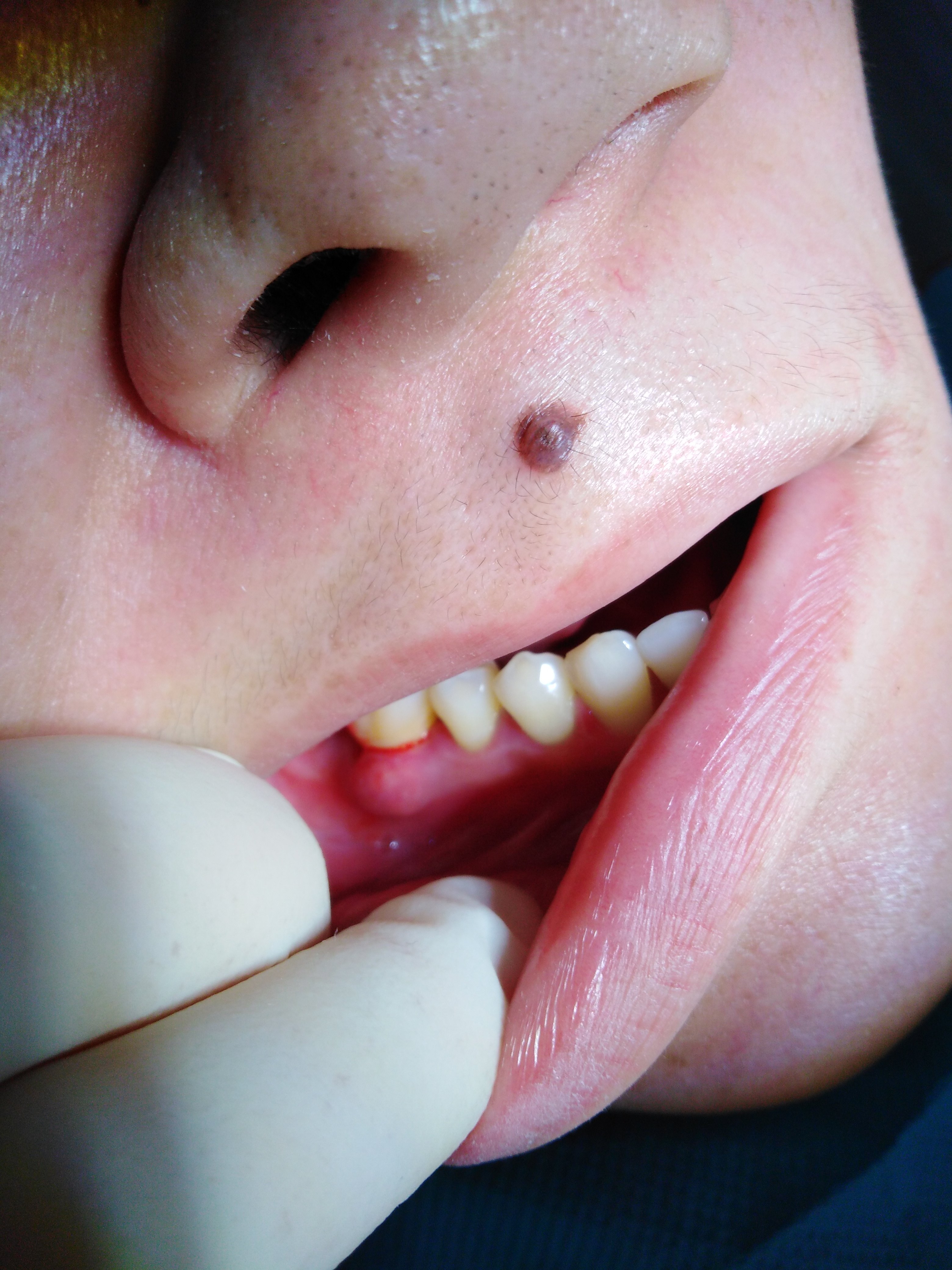 牙周脓肿一例 