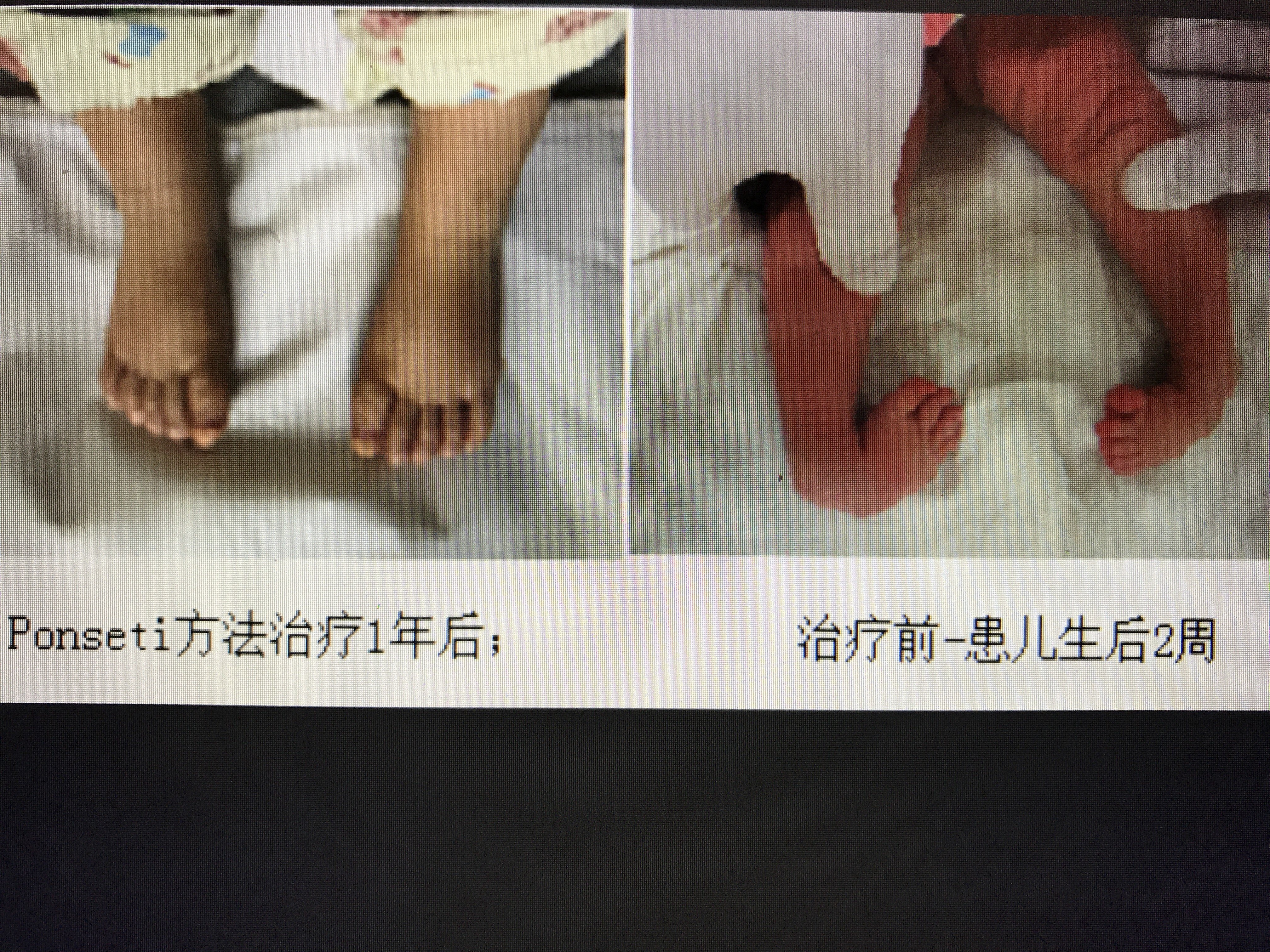 足踝专家胡霞主任科普:如何尽早发现和治疗婴幼儿马蹄足内翻？ - 哔哩哔哩