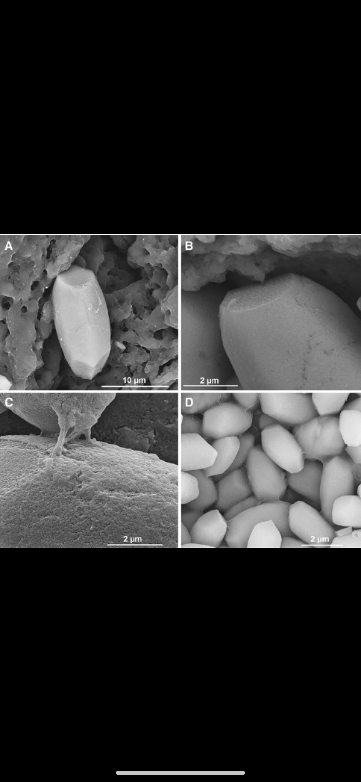 耳石症中的耳石到底长什么样子