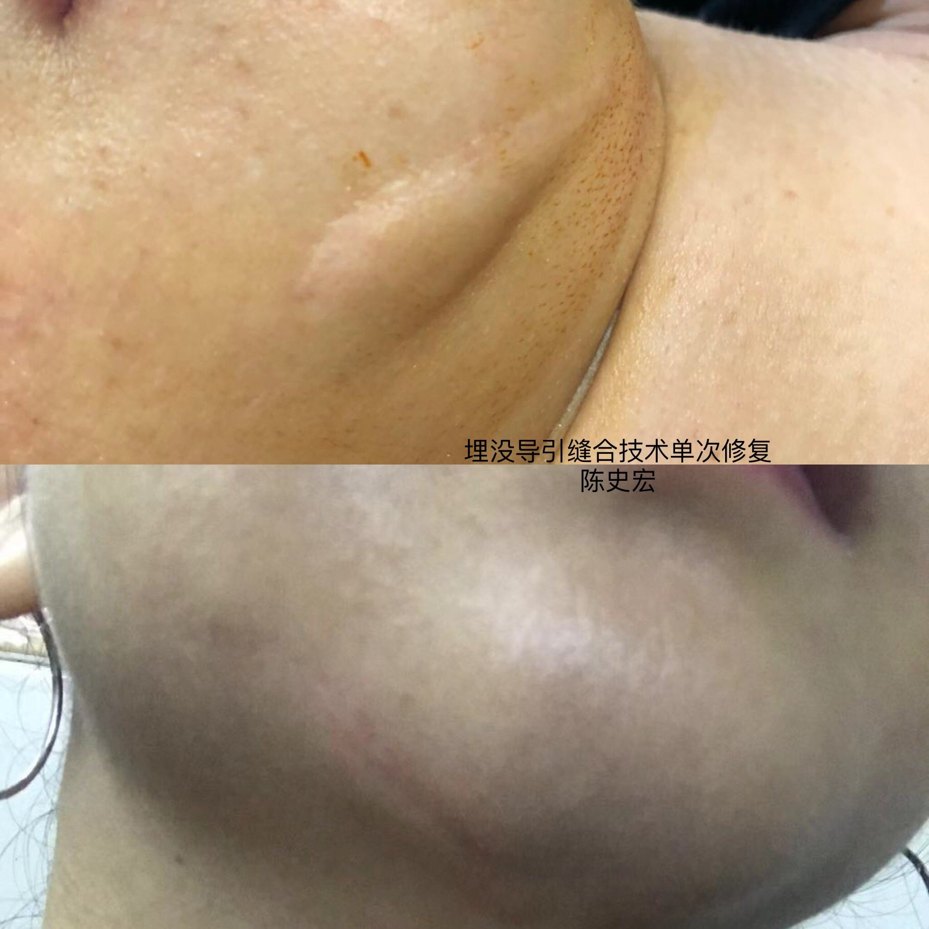 疤痕修复案例 - 好大夫在线