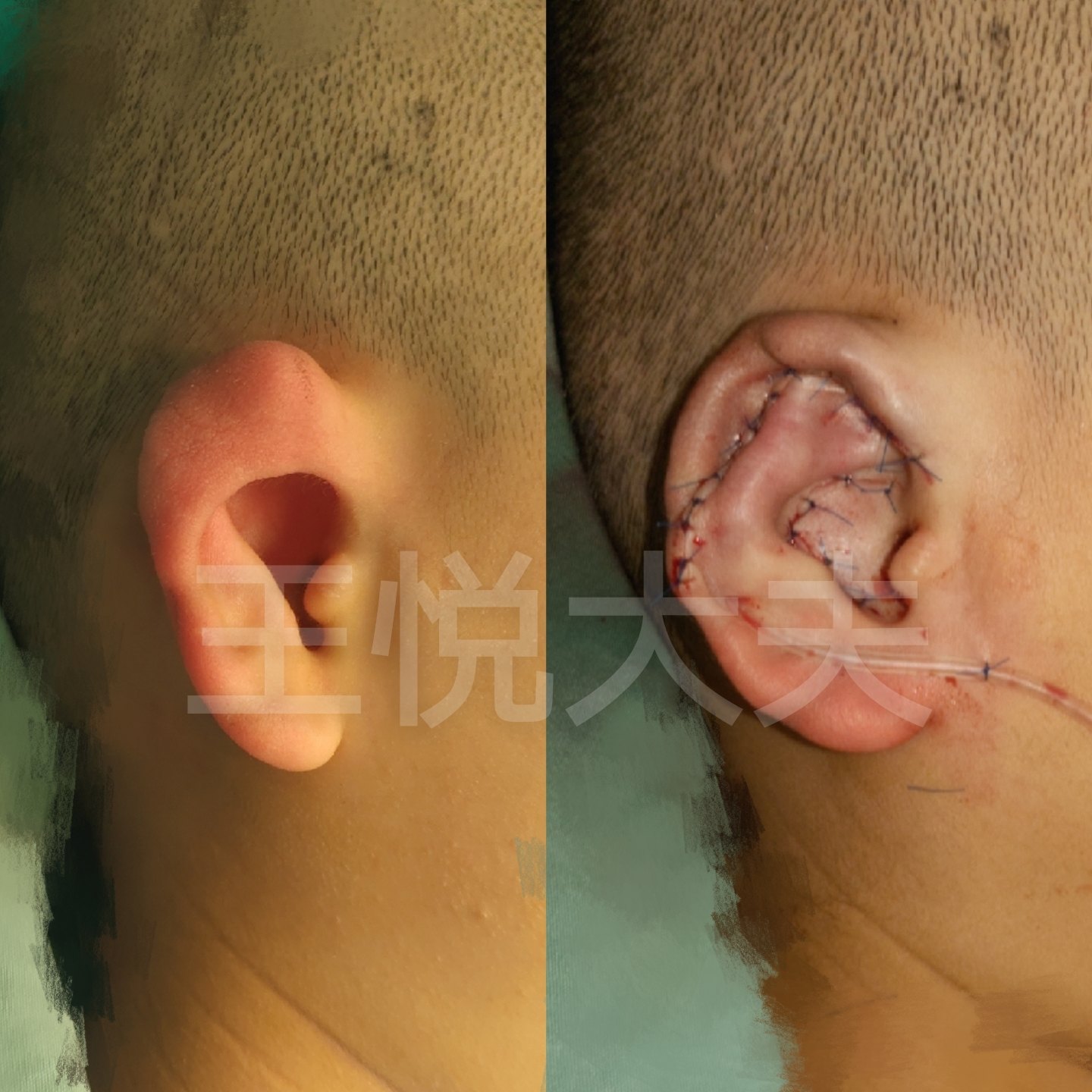 杯状耳,耳畸形矫正新术式一次成形_耳部整形_耳部整形治疗介绍 - 好