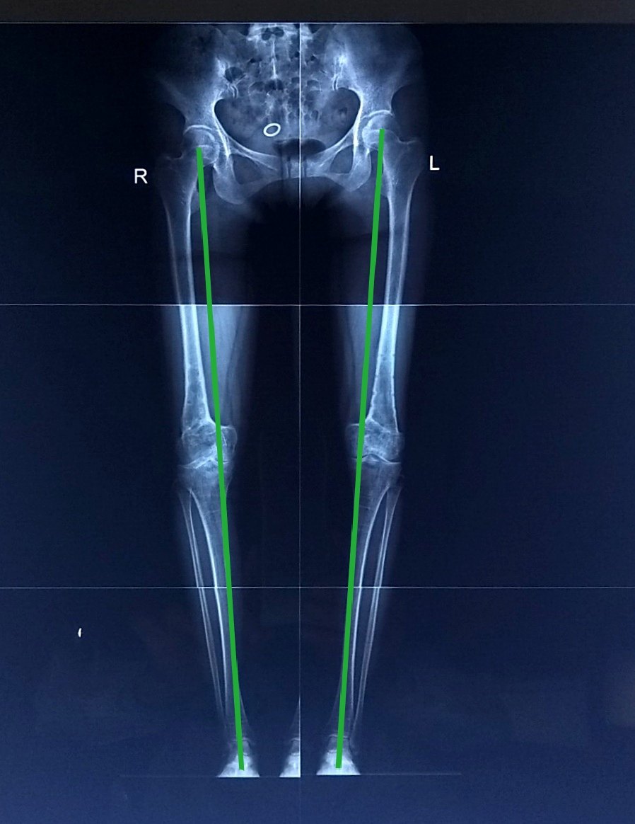 43岁女性,重度外翻膝,疼痛行走困难,双侧截骨矫形术 - 好大夫在线
