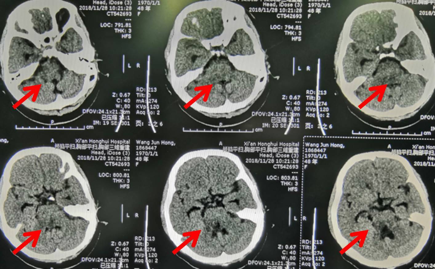 出生3天婴儿脑CT报告，昨天剪脐带大量出血后，睡一觉后发现全身抽动，持续不到1分钟 - 百度宝宝知道