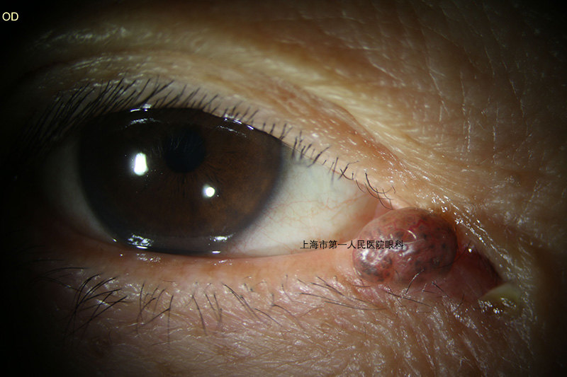 眼睑色素瘤图片