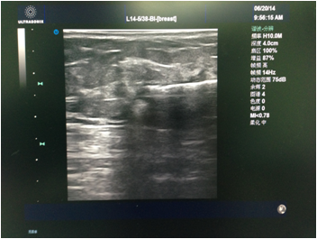 1552446920590244.png 乳腺微创手术切除乳腺结节