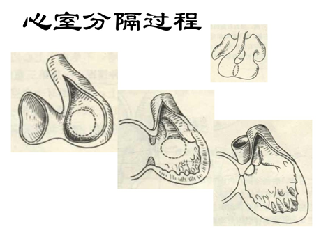 常见先天性心脏病