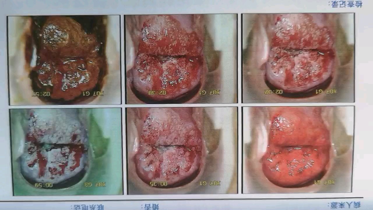 宫颈癌晚期掉烂肉图片图片