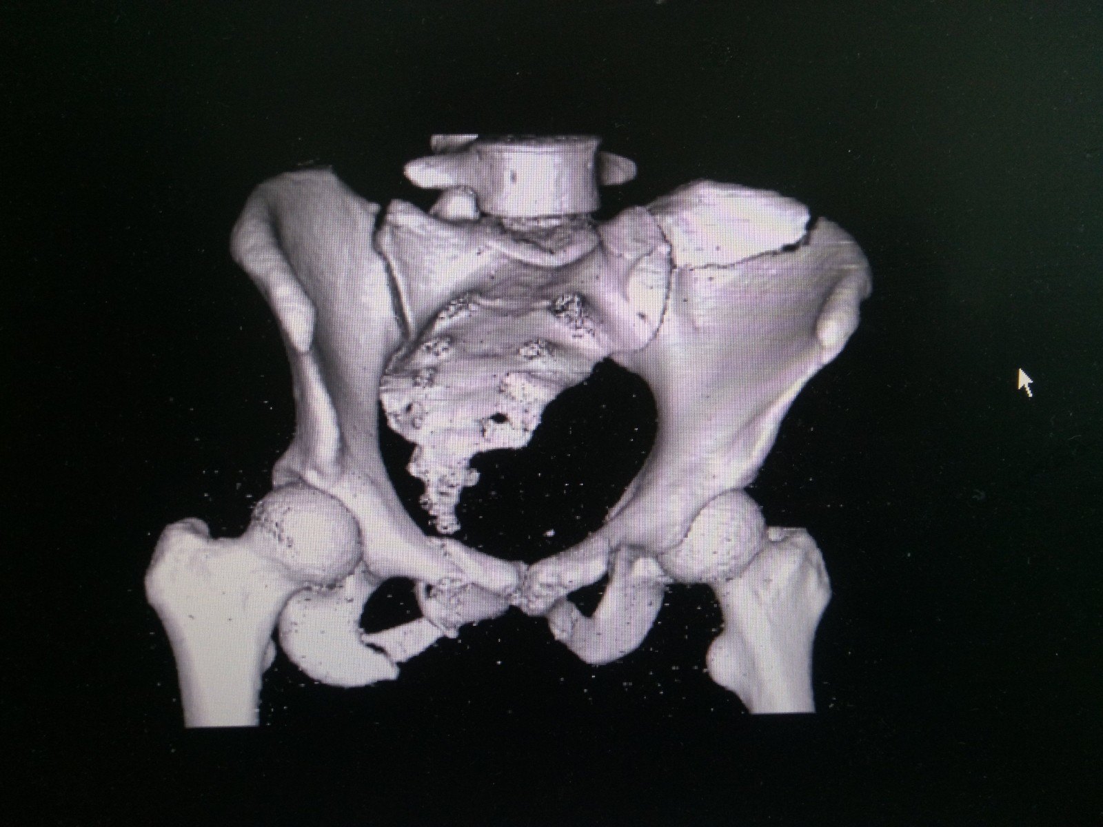 左侧耻骨下肢骨折图片图片