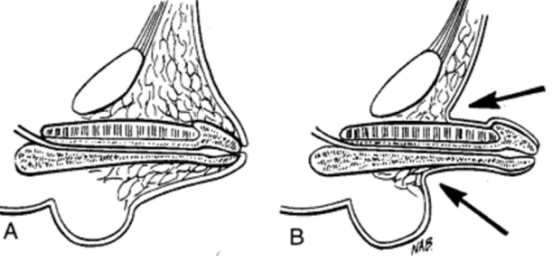 曙光召唤森林,小鸟飞起来---隐匿阴茎延长术_男性生殖器畸形_疾病介绍