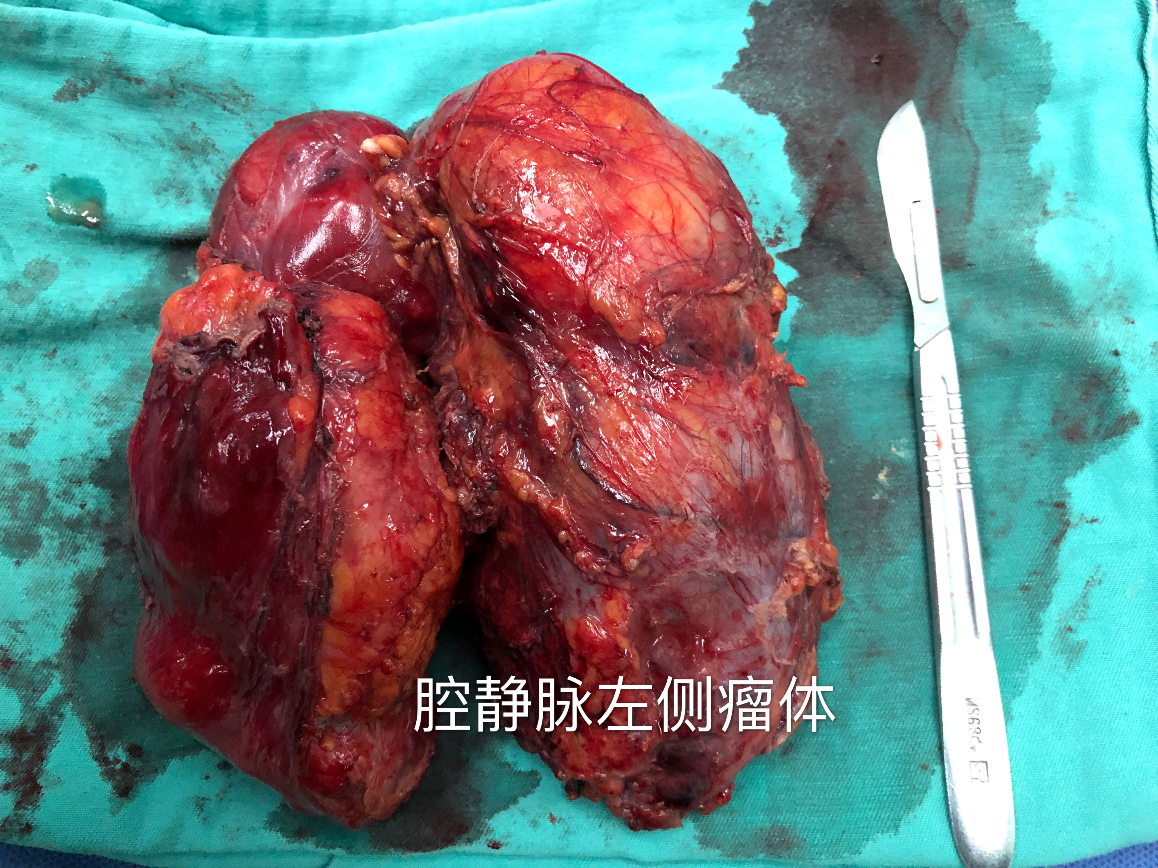 腹膜后巨大畸胎瘤一例 