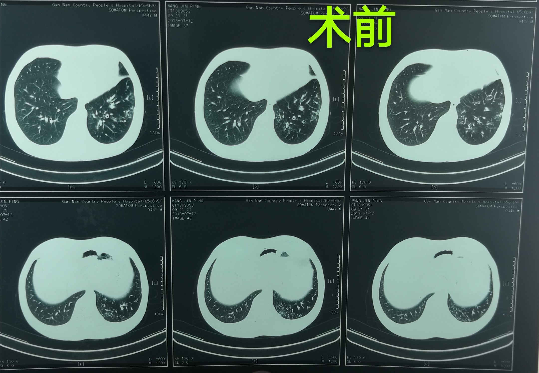 哈医大二院胸外科经典病例之支气管扩张