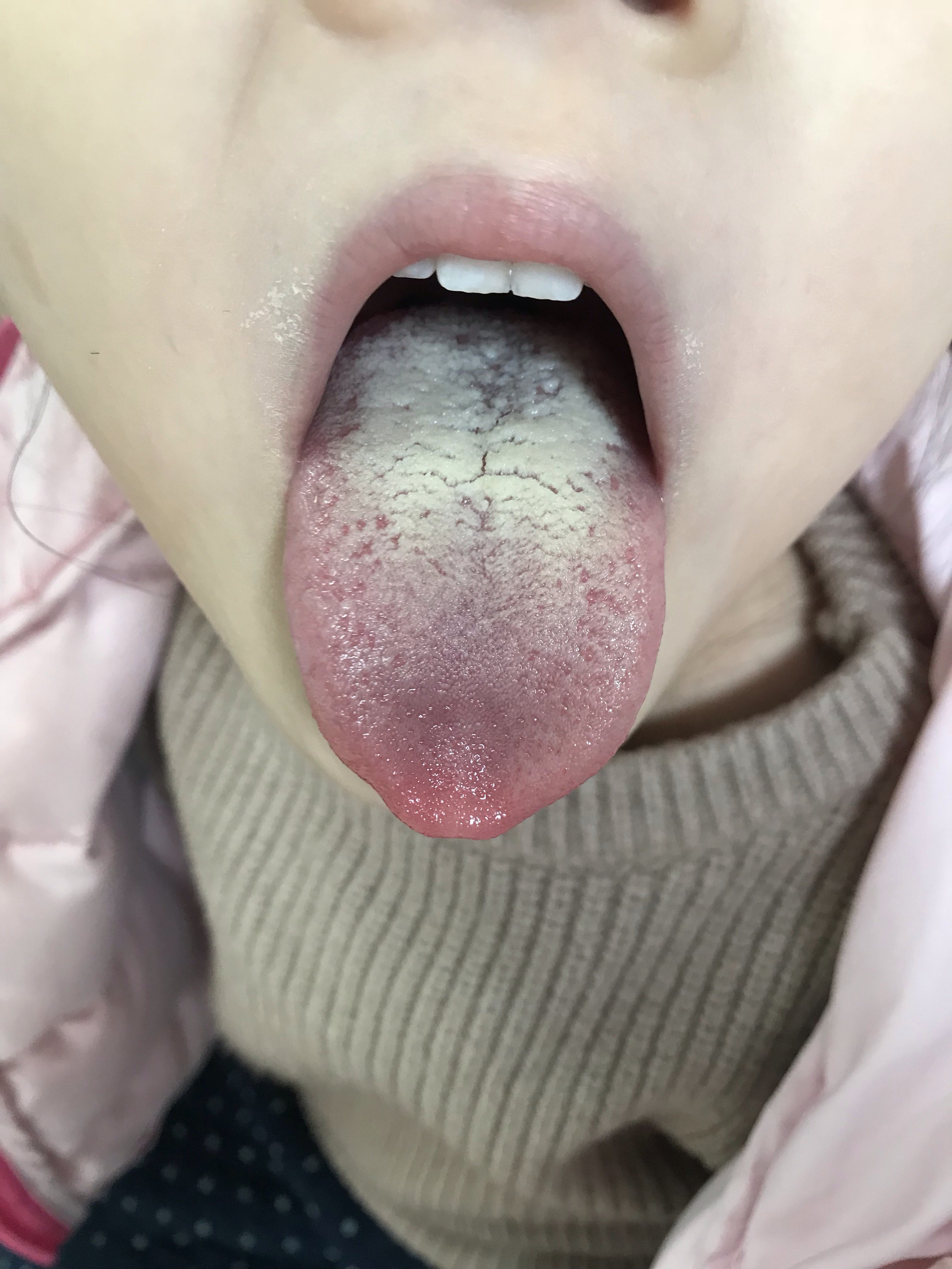 小儿舌苔厚腻是什么原因 小儿舌苔厚腻是什么原因