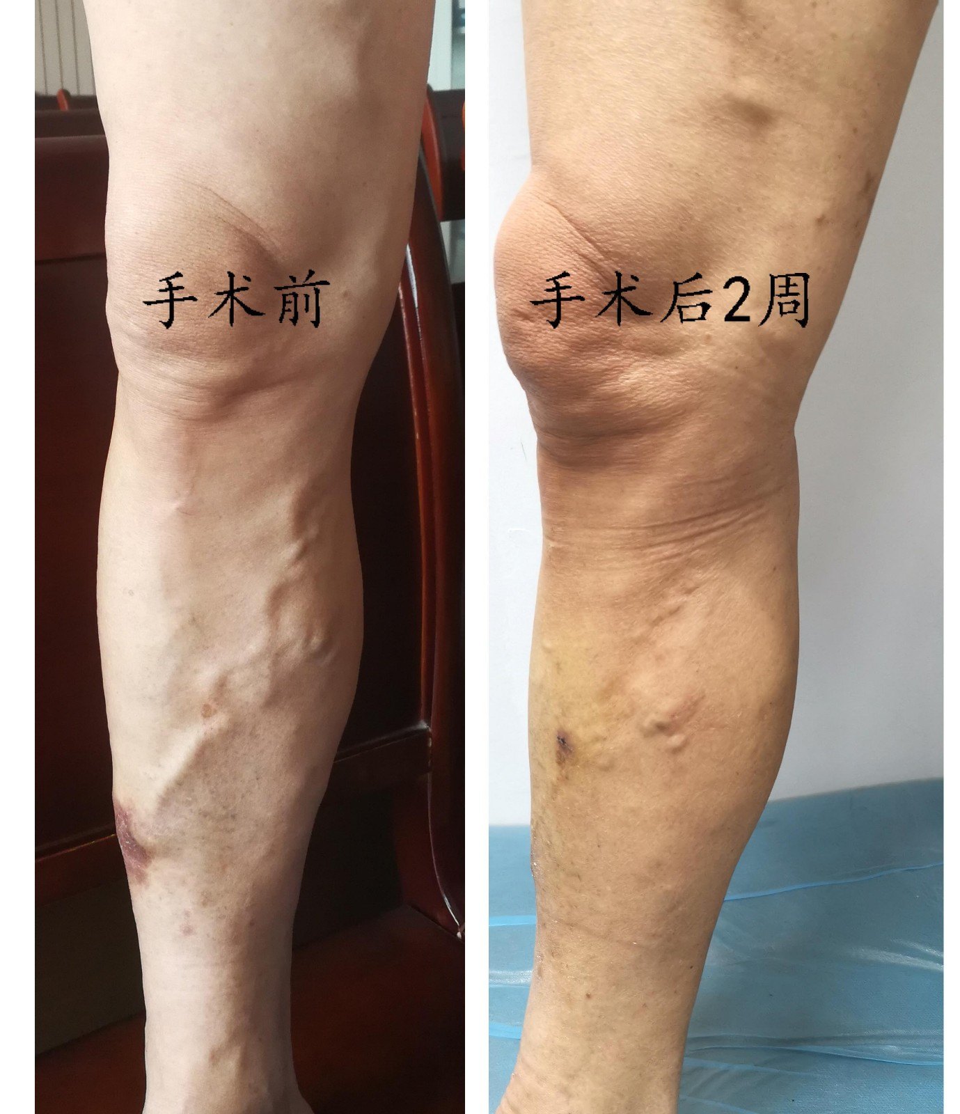 因此,我们无需因害怕麻醉和手术而拖延下肢静脉曲张的治疗.
