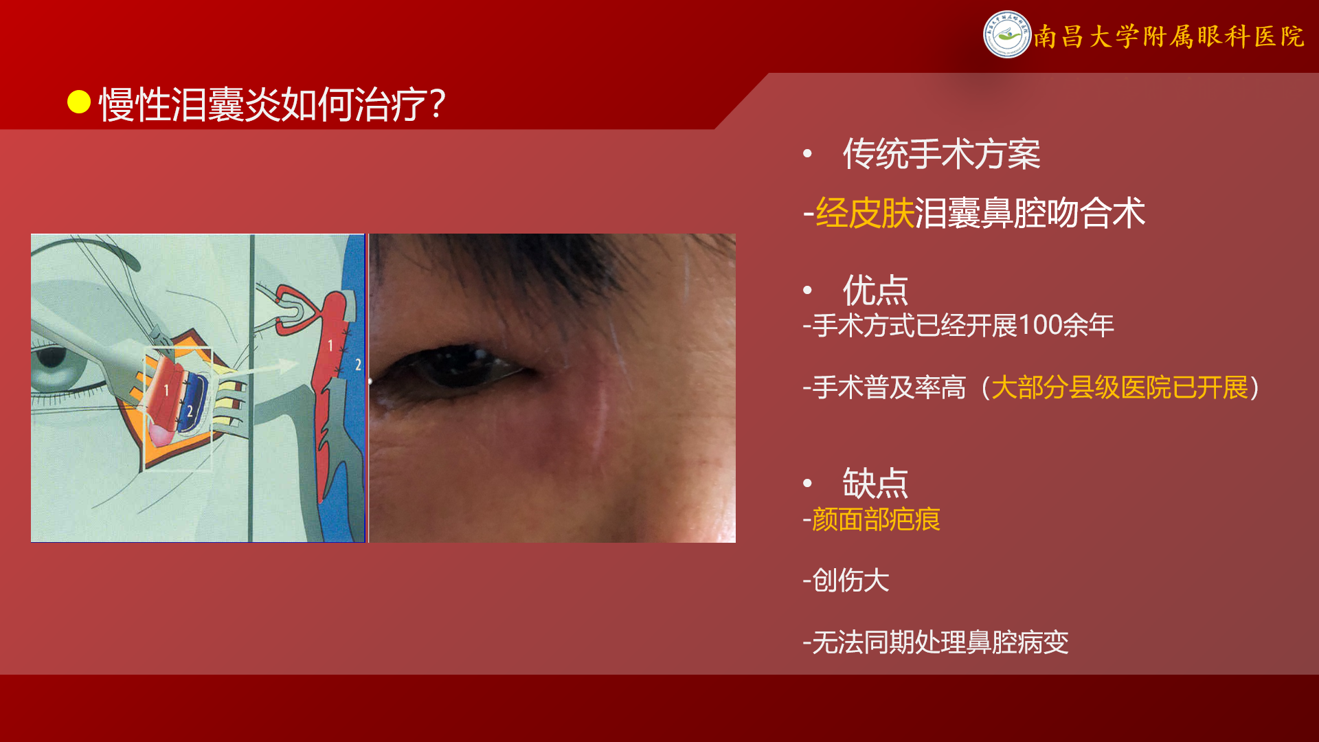 “泪囊炎”如何治疗? - 好大夫在线
