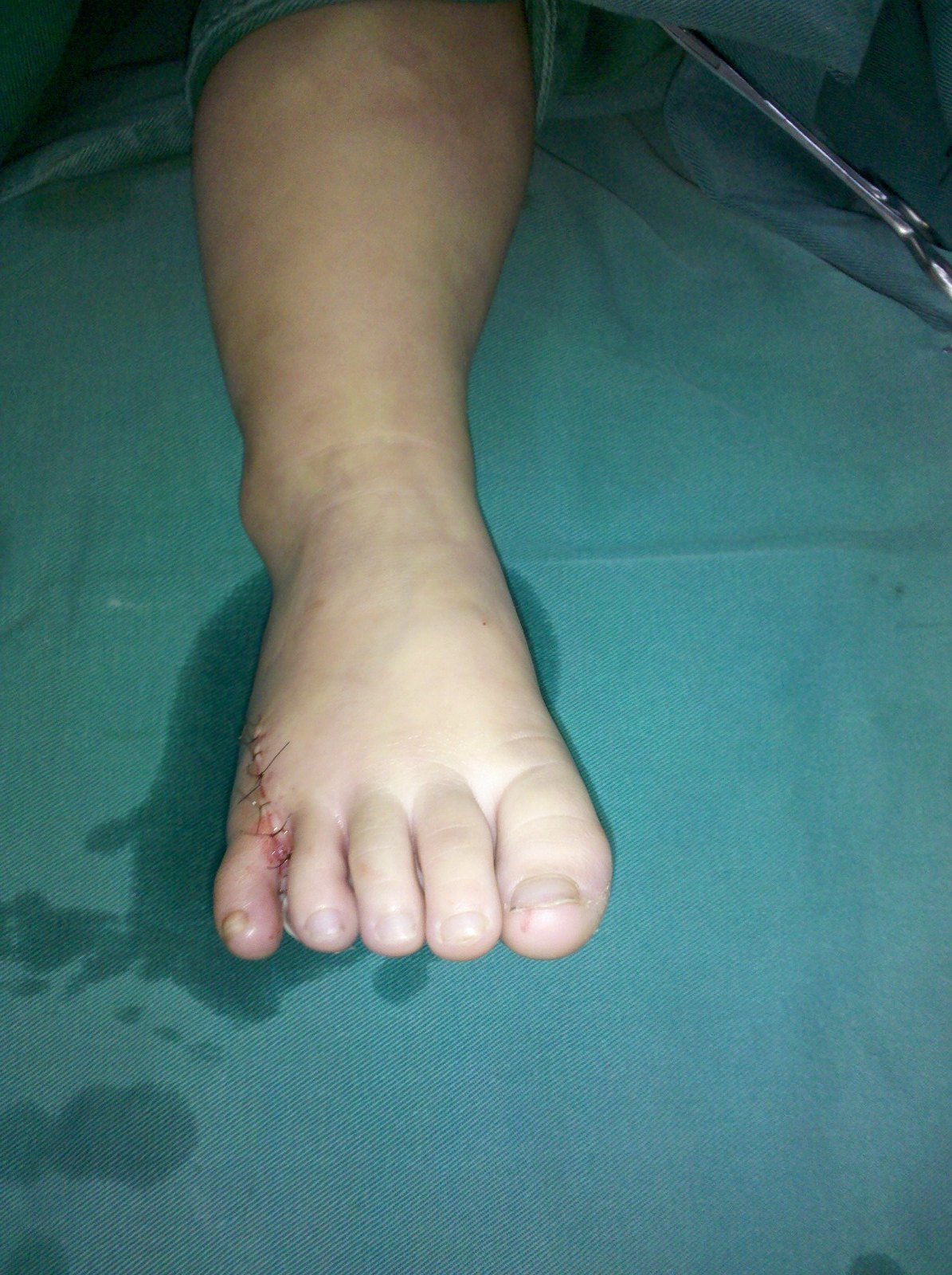 先天性并指多指畸形_手术_治疗方式 - 好大夫在线