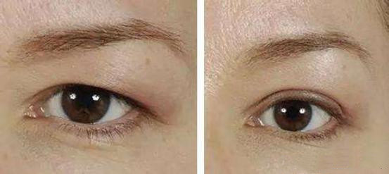 眼皮下垂了该怎么办