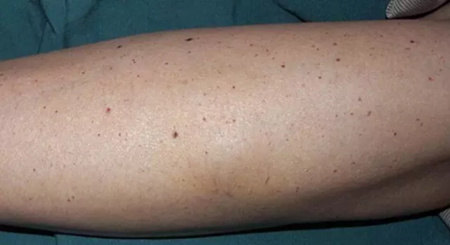 身上"红痣",不用怕!--樱桃样血管瘤的真相