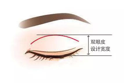 双眼皮术前切口设计宽度,就是平时所说的双眼皮割的宽度,指的就是闭眼