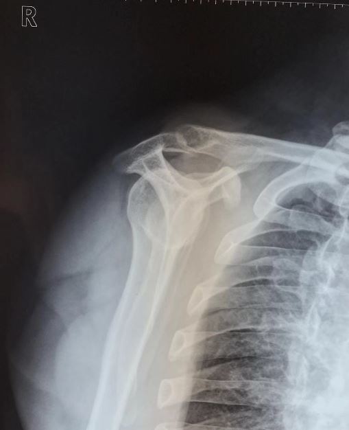 美国肩关节专家bigliani将肩峰形态分型分成哪三种类 - 好大夫在线