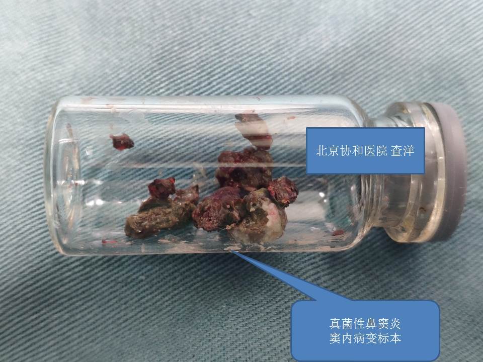 真菌性鼻竇炎患者手術常見問題及注意事項