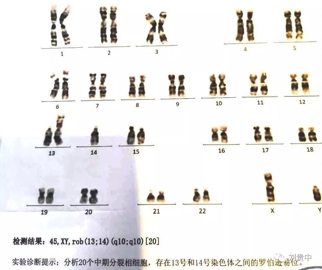 染色体核型异常(45,xy,rob(13;14(q10;q10)罗氏易位(罗伯逊易位)是