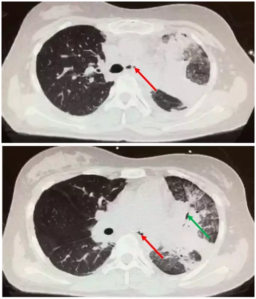 "致命霉栓"(1)---阻塞性支气管毛霉病 - 好大夫在线