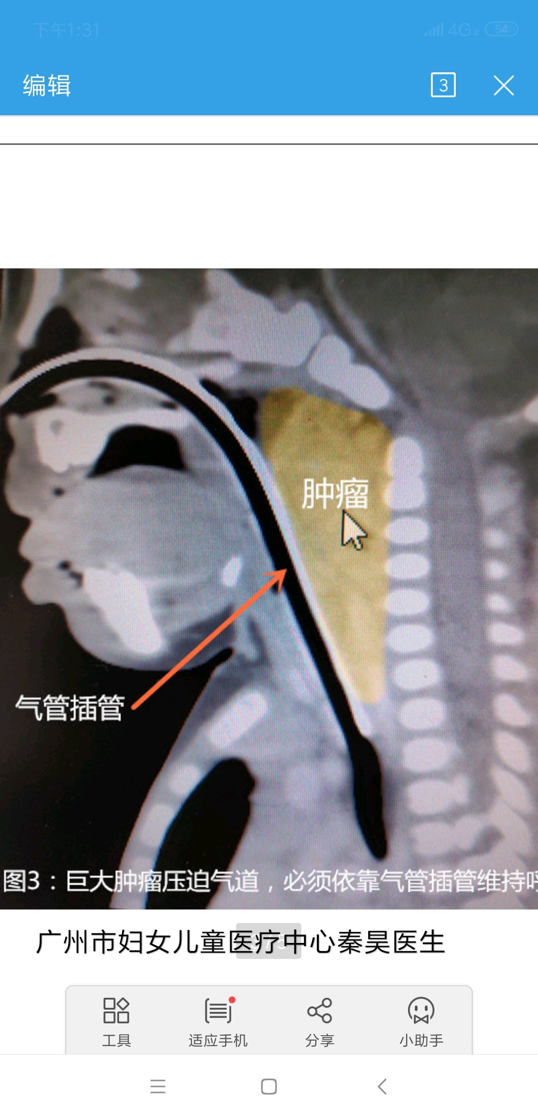 脖子内部气管图片图片