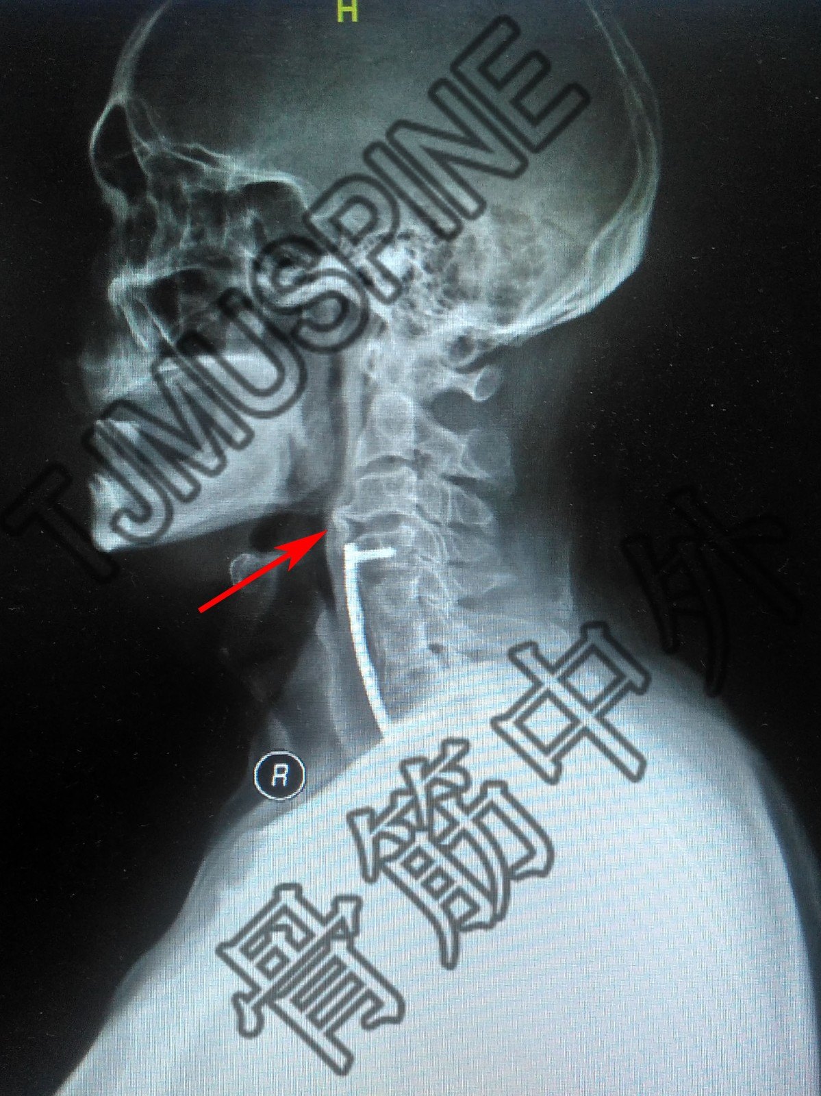 頸椎結核術後脊髓型頸椎病