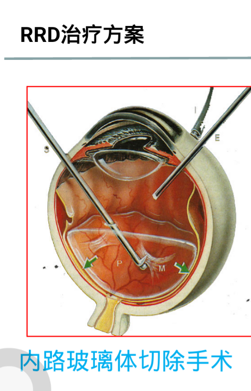 眼睛玻璃体切除图片