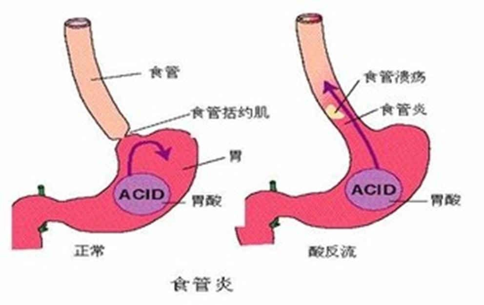 第三問:什麼是胃食管反流病和反流性食管炎?