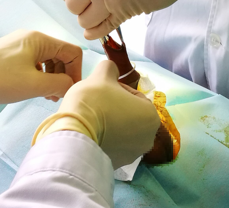 准备合适型号吻合器手术步骤精解根据阴茎大小选择不同吻合器型号吻合