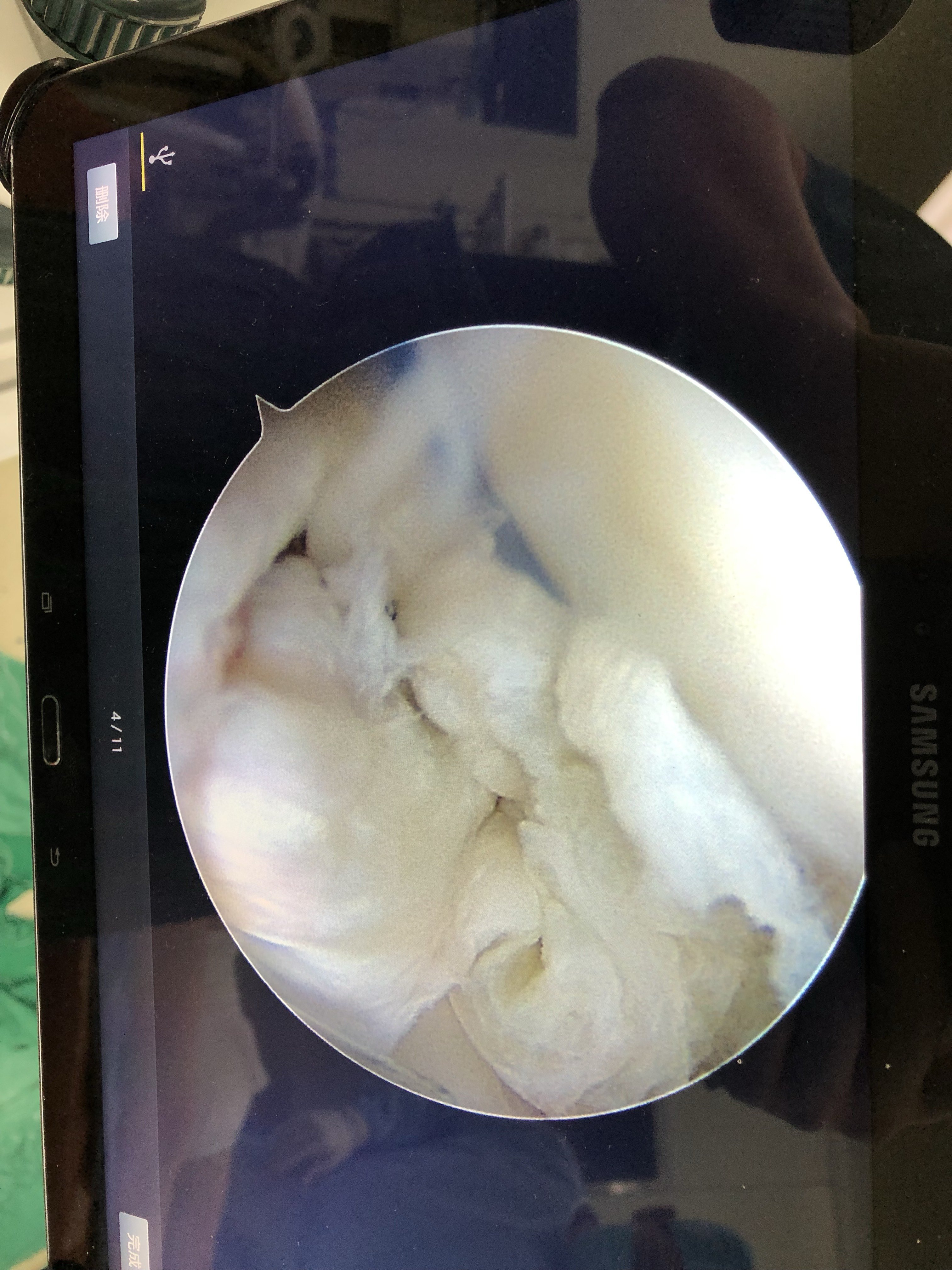盘状半月板手术图片