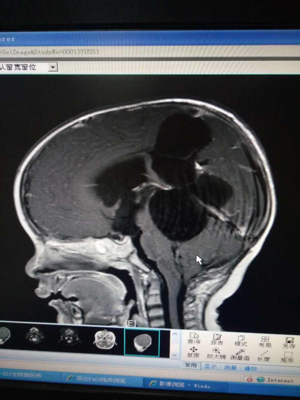 孩子媽媽說,孩子小時候鬧病時很重,現在孩子一切正常,而且不帶分流管